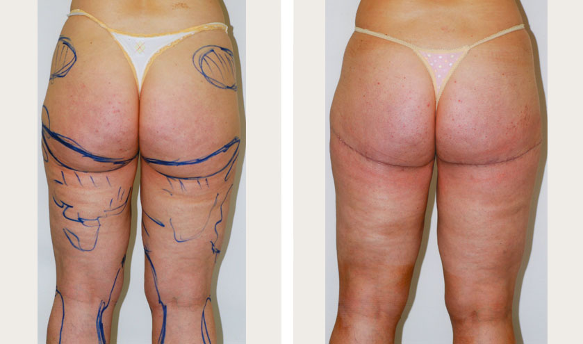 What makes you a good candidate for buttock augmentation using fat transfer?