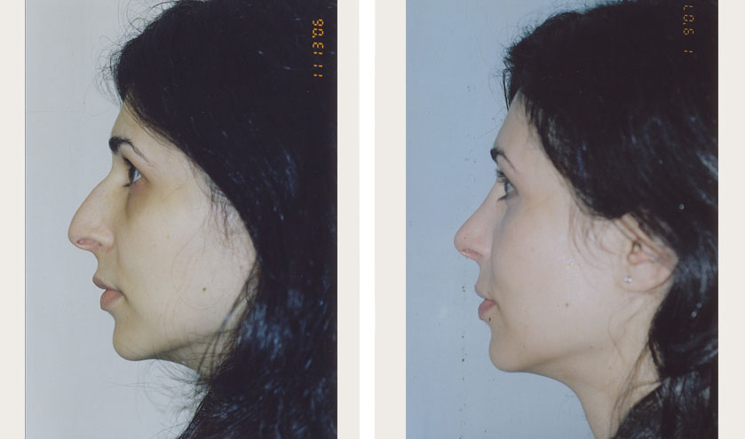 bad rhinoplasty before and after