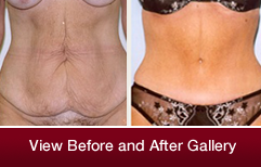 Tummy tuck NYC  Upper East Side Plastic Surgeon