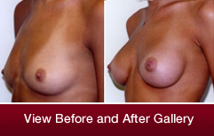 before and after  breast agumentation by Dr. Thomas Loeb Manhattan plastic surgeon