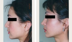 Nose-Surgery-blackout3-bna