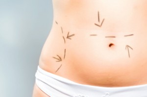 Back Fat Liposuction NYC