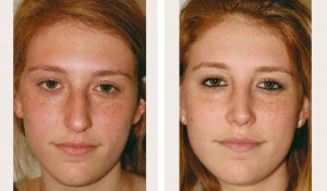 rhinoplasty before and after photos