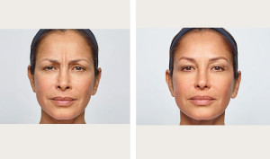 botox before and after picture