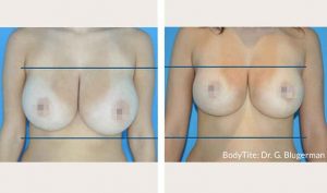 bodytite-breast-bna