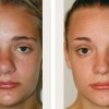 Nose Job NYC - Researchers Study Rhinoplasty Voice Changes