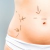 Tummy tuck lipo