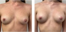 Breast augmentation Before and After