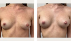 Breast augmentation Before and After