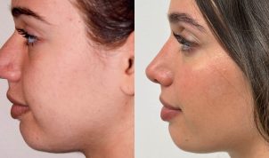 Four years post-rhinoplasty with narrowing of bones, thinning and sharpening of the tip, lowering of the dorsum, and narrowing of the nostrils. The thicker skin and narrow poorly defined tip present a big challenge!