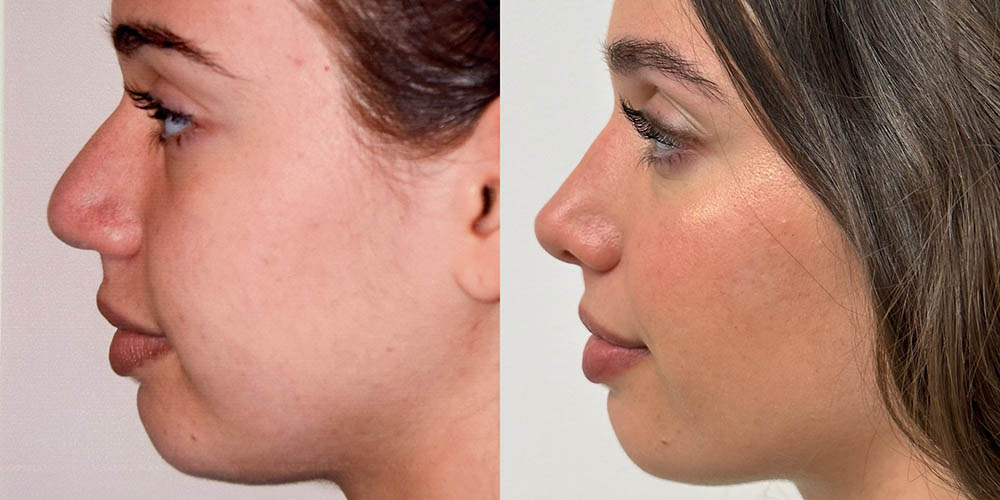 Four years post-rhinoplasty with narrowing of bones, thinning and sharpening of the tip, lowering of the dorsum, and narrowing of the nostrils. The thicker skin and narrow poorly defined tip present a big challenge!