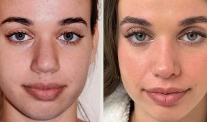 Four years post-rhinoplasty with narrowing of bones, thinning and sharpening of the tip, lowering of the dorsum, and narrowing of the nostrils. The thicker skin and narrow poorly defined tip present a big challenge!