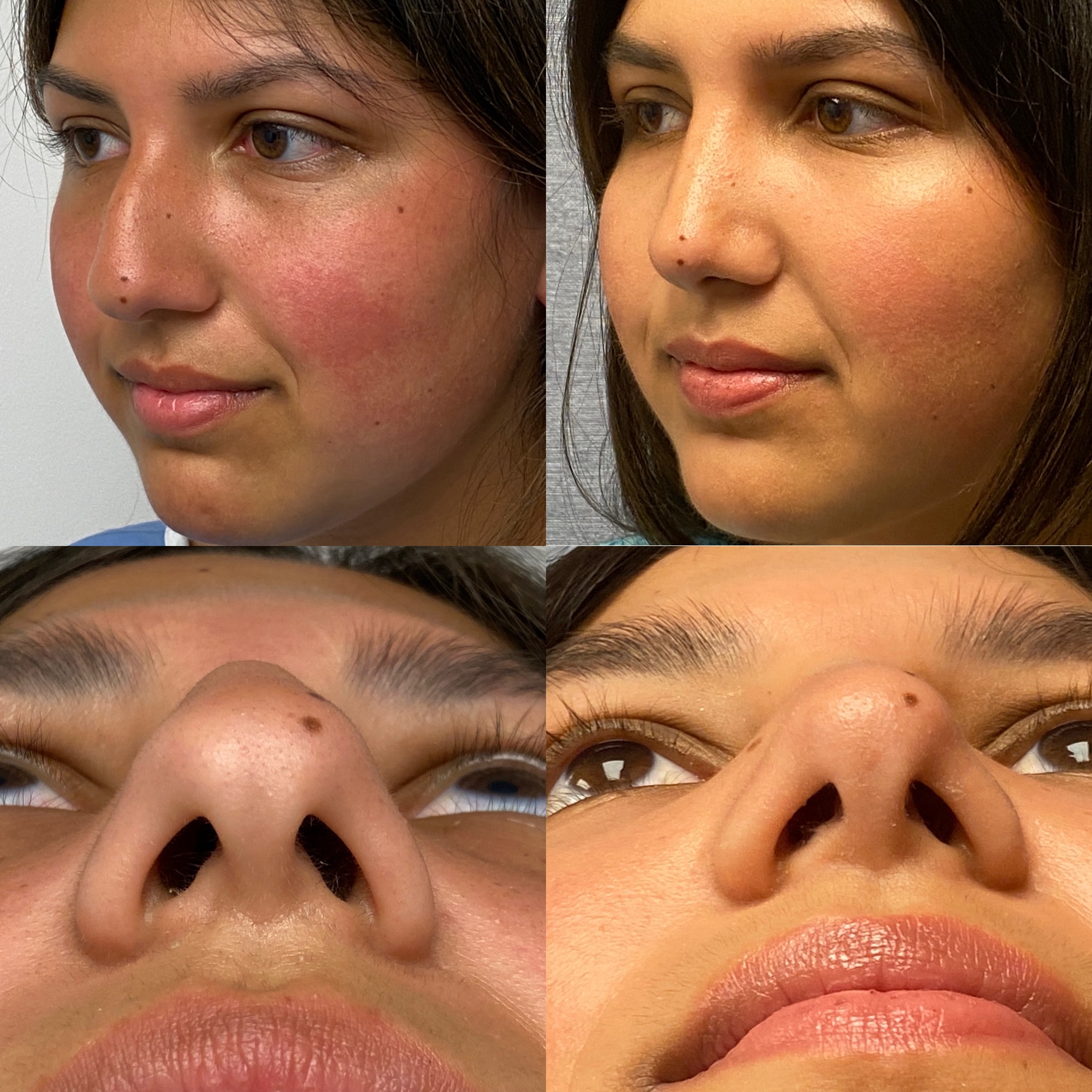 Rhinoplasty - 1 year after sharpening tip and lowering bump. So natural and beautiful.