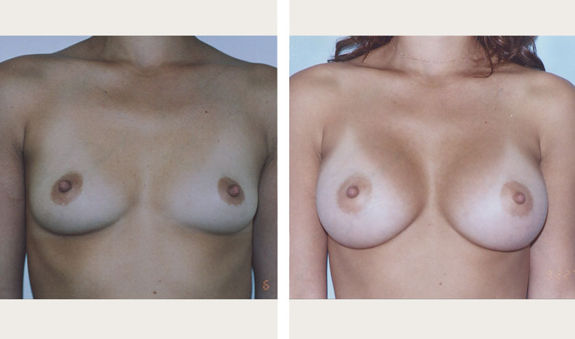 breast implant small breast nyc breast surgeon. 