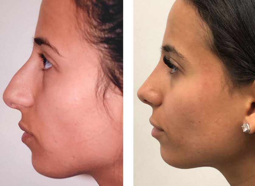 Teen girl side profile after rhinoplasty procedure done by Dr. Loeb NYC. 