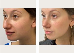 Young lady rhinoplasty recovery day by day also a before and after image showing results. 