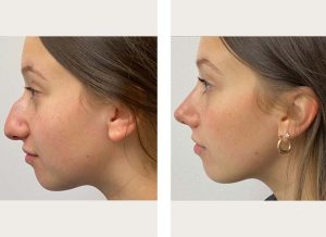 Young lady side view rhinoplasty recovery