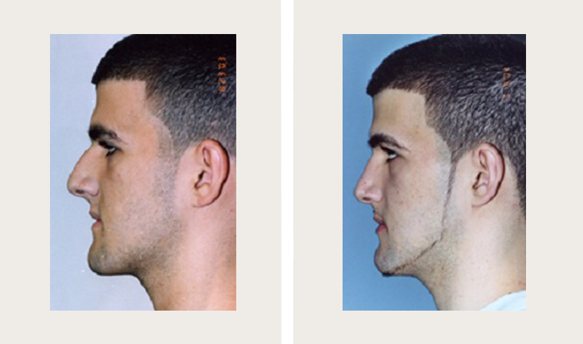 Adolescent boy side profile after rhinoplasty procedure done by Dr. Loeb Manhattan NY. 