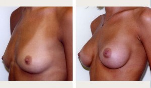 breast augmentation before and after picture