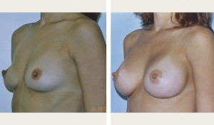 breast implant before and after photo