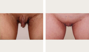 labiaplasty before and after image of a woman who has undergone labiaplasty.