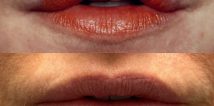 Lip augmentation by Dr. Loeb