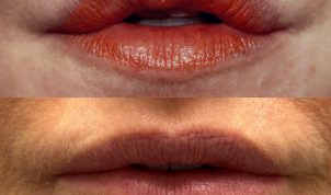 Lip augmentation by Dr. Loeb