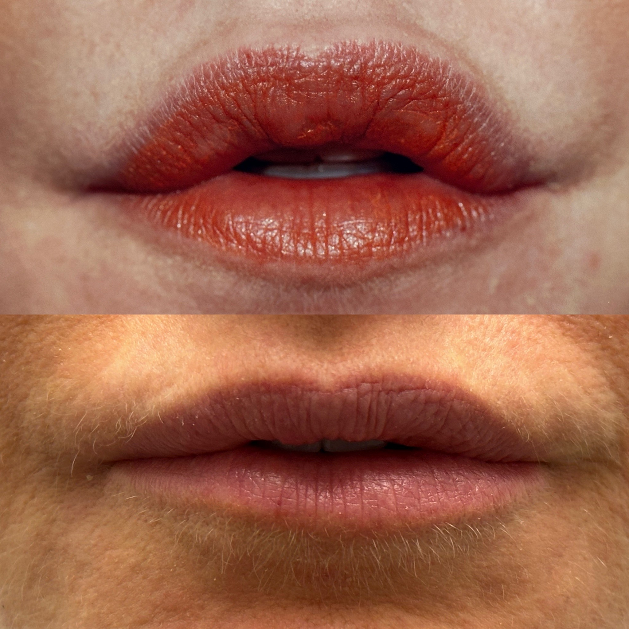 Lip augmentation by Dr. Loeb