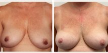 4 years after nipple areola reduction and lift.
