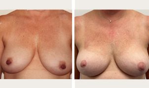 4 years after nipple areola reduction and lift.