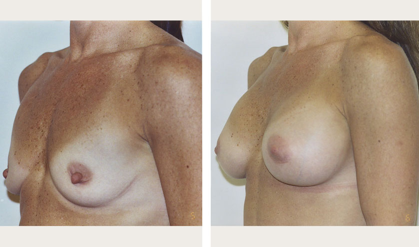 breast augmentation medium size breast nyc plastic surgeon.