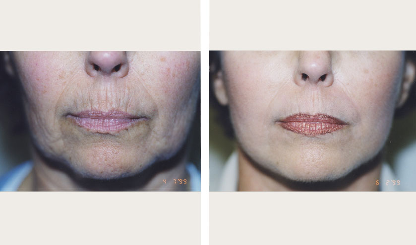 Dermabrasion Before and After | Dr. Thomas Loeb
