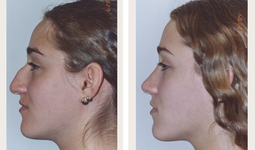Self-image improves following nose job surgery.