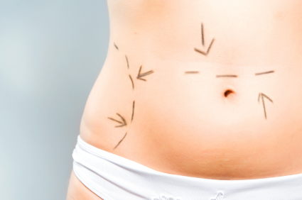 My Tummy Tuck Nightmare - I Was Botched 