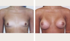breast augmentation revision before and after nyc