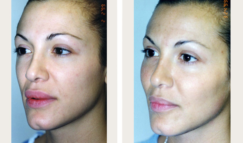 Cheek Implants Before and After | Cheek Fillers Before and After