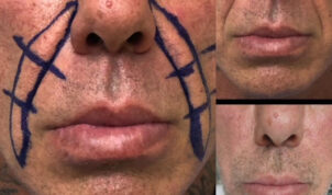 Nasolabial Fold Lift Before and After