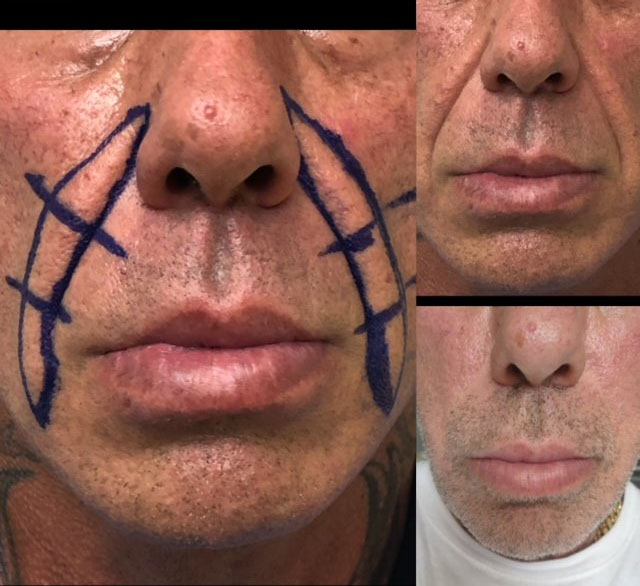 Nasolabial Fold Lift Before and After