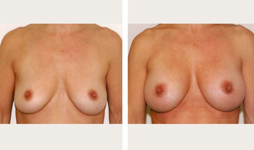 breast augmentation white female nyc cosmetic surgeon.