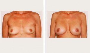 breast augmentation with axilliary liposuction