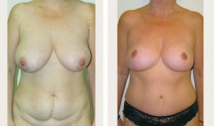 breast reduction and tummy tuck