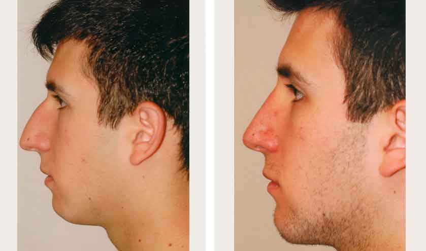 Teen boy side profile after rhinoplasty procedure done by Dr. Loeb Manhattan NY. 