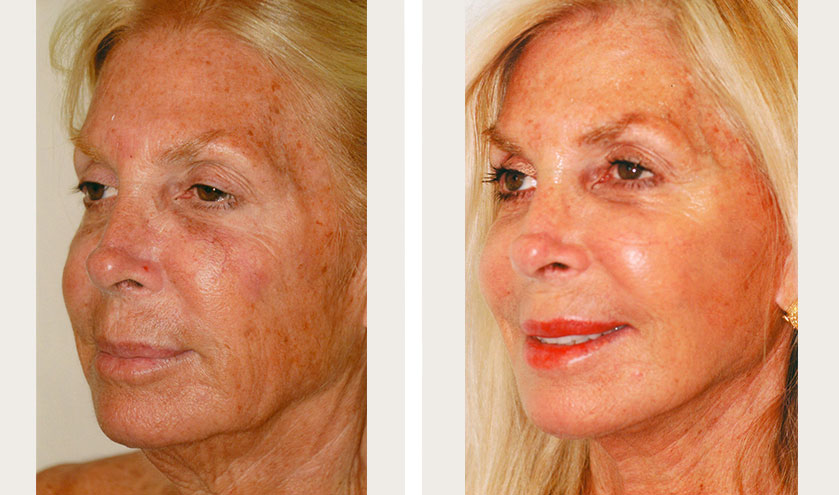 Woman who recently had a facelift. 
