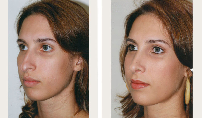 Rhinoplasty NYC Cost, Recovery, Reviews, Before & After Pics