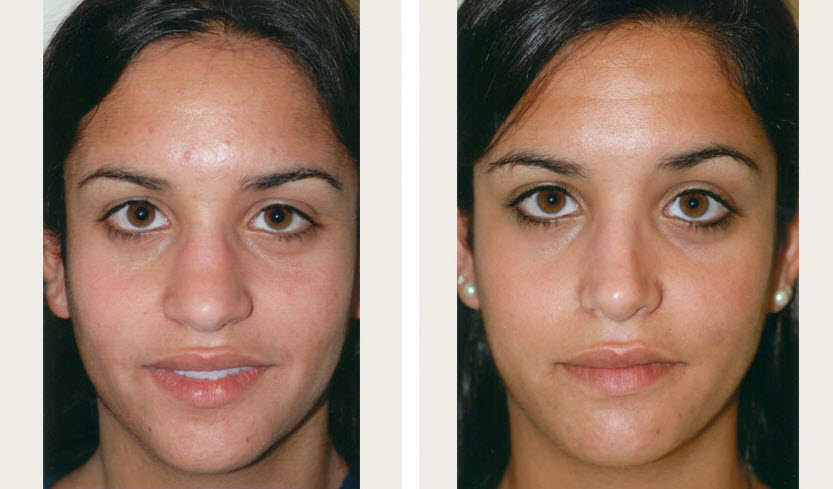 Rhinoplasty NYC Cost, Recovery, Reviews, Before & After Pics