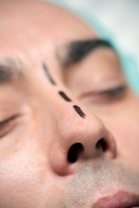 white male prep for secondary (revision) rhinoplasty. 