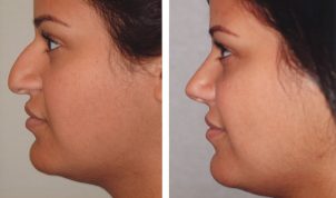 rhinoplasty before and after