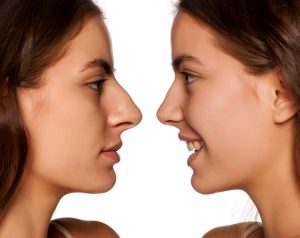 before and after rhinoplasty