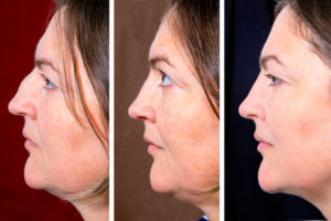 woman nose and double chin plastic surgery before and after