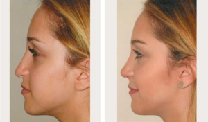 side view revision rhinoplasty